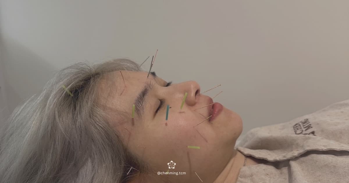 Facial Acupuncture at Chenming TCM Clinic, Bangkok Chinatown near Hua Lamphong MRT